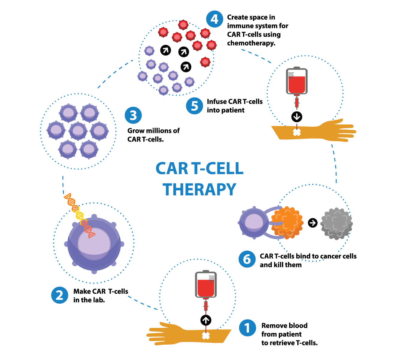 CAR T Therapy In New York car-t-therapy-in-new-york
