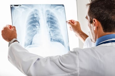 What Does a Lung Nodule Mean for My Health?
